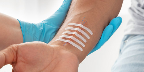 Helsepersonell med blå hanske holder en underarm med fem sårlukkingsstrips plassert på håndleddet. Helsepersonell med blå hanske holder en underarm med fem sårlukkingsstrips plassert på håndleddet.